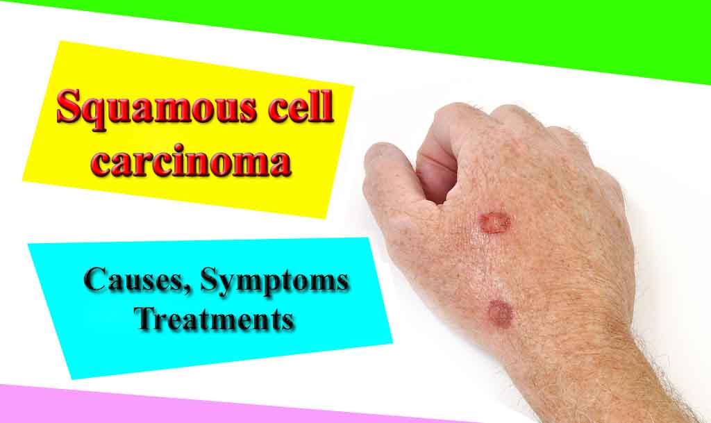 Squamous cell carcinoma â Causes, Symptoms, Treatments and ...