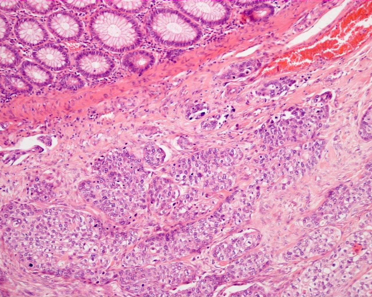 Squamous cell carcinoma arising in a mature cystic ...