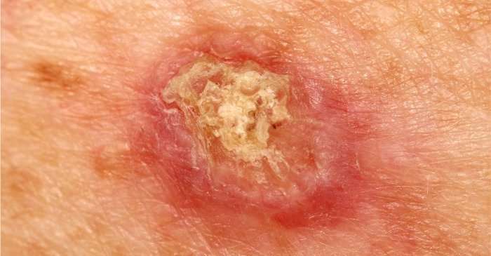 Squamous Cell Carcinoma: Causes, Symptoms, Prevention ...
