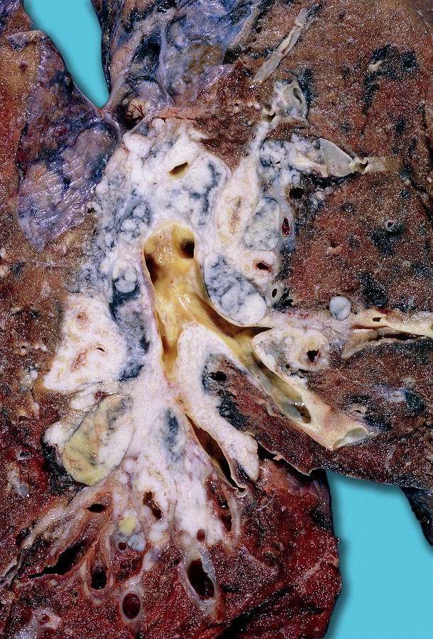 Squamous Cell Carcinoma Lung Cancer Photograph by Medimage ...