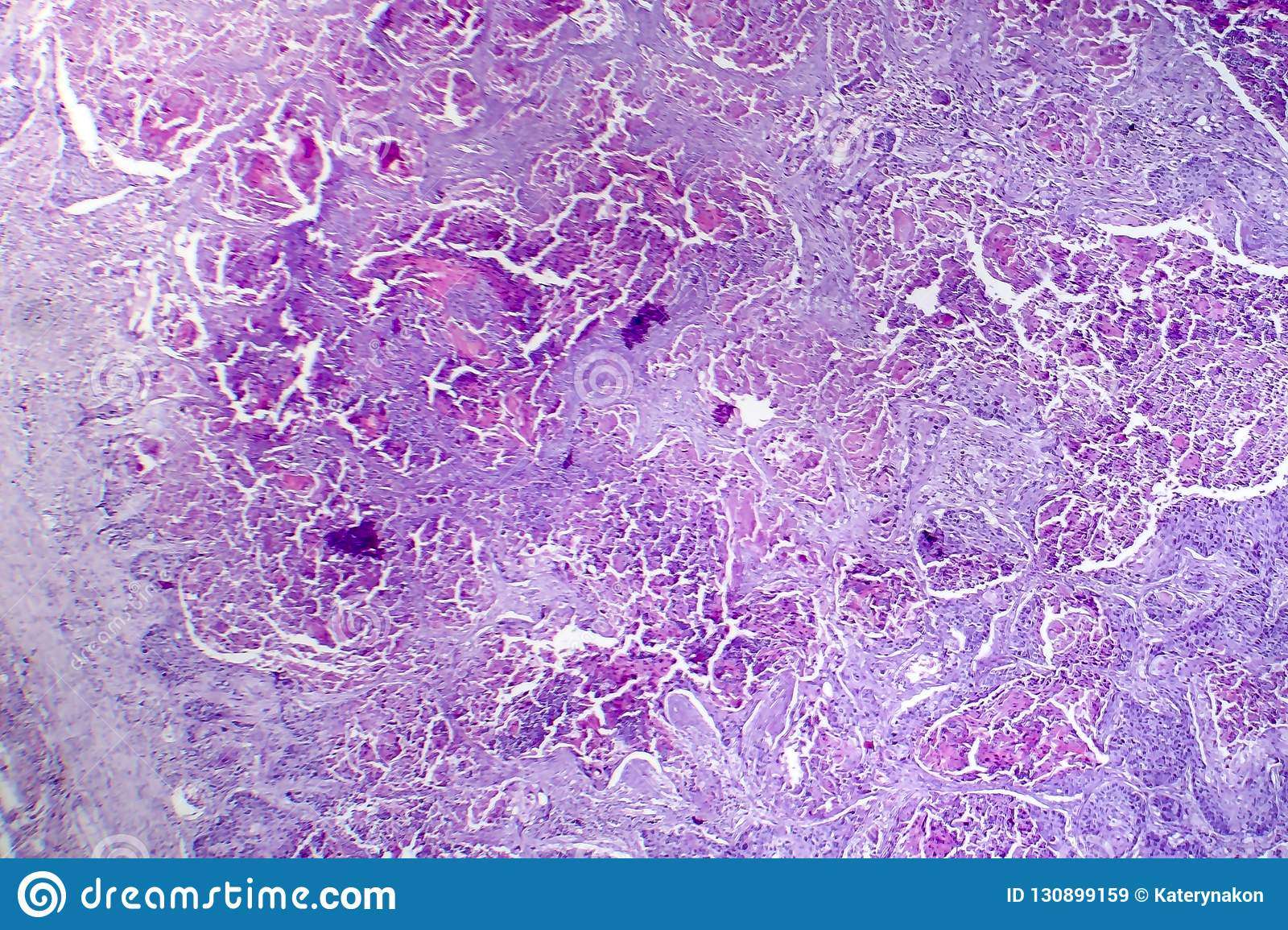 Squamous Cell Carcinoma Of The Lung Stock Image