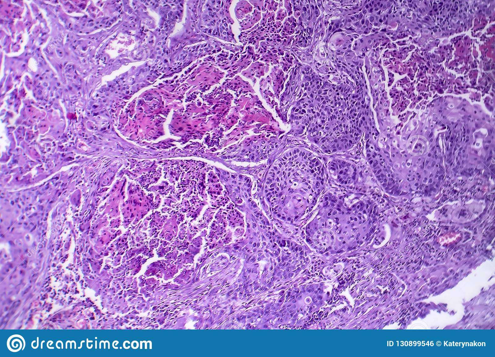 Squamous Cell Carcinoma Of The Lung Stock Photo
