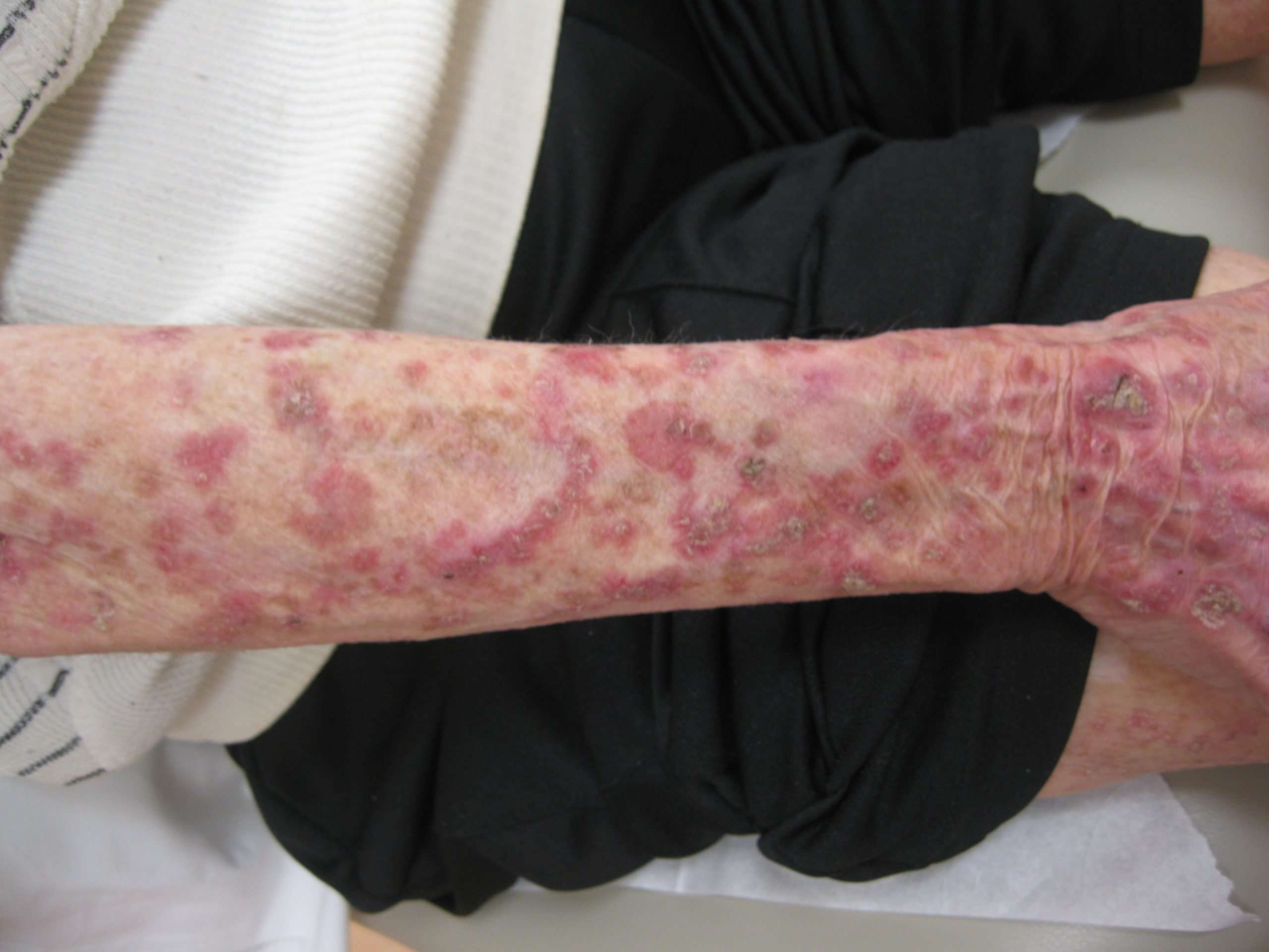 Squamous Cell Carcinoma of the Skin