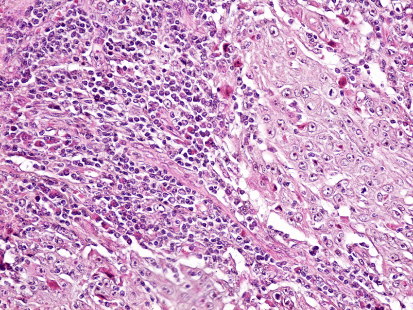 Squamous cell carcinoma poorly differentiated. HE staining ...