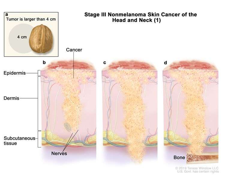 Squamous cell carcinoma (SCC), a skin cancer