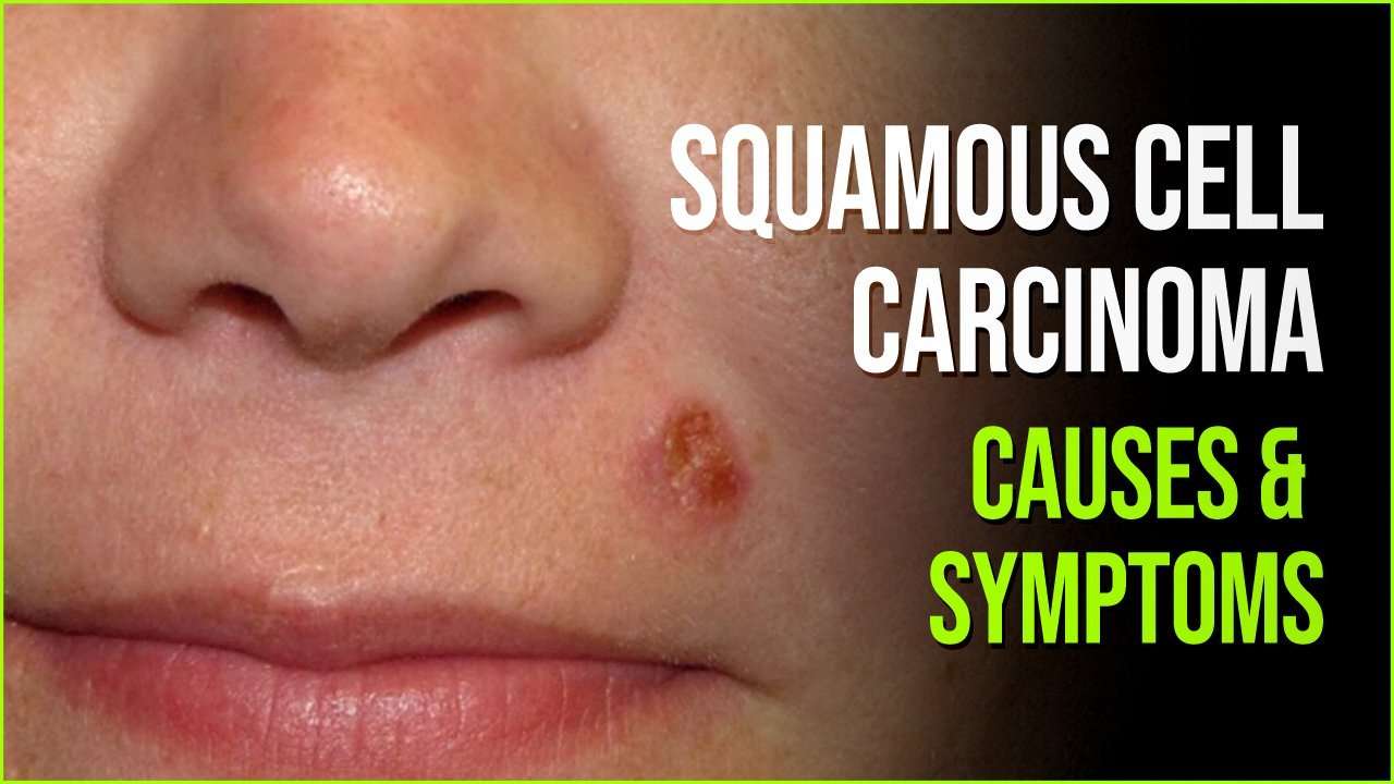 Squamous Cell Carcinoma: Second Most Common Type of Cancer