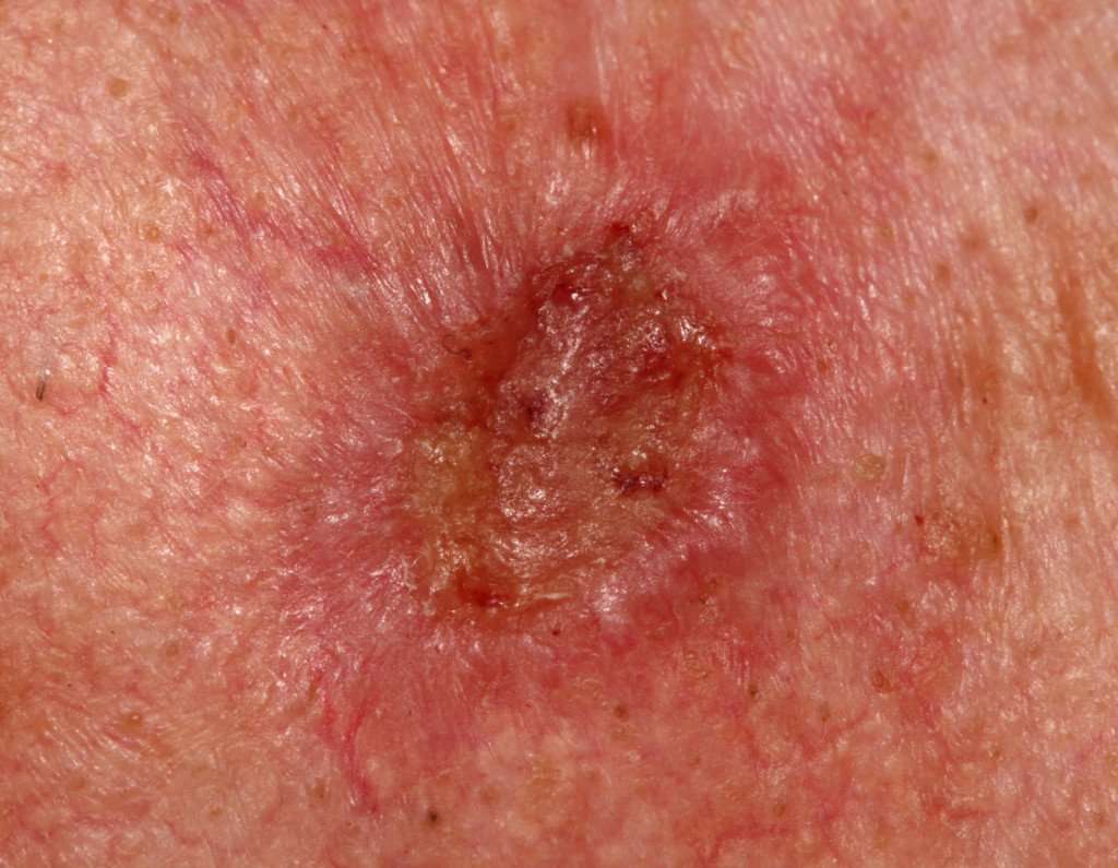 Squamous Cell Carcinoma Skin Cancer Questions Answered ...