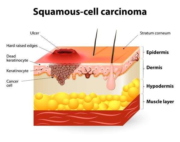 SQUAMOUS CELL CARCINOMA (Source: Genetic home Reference ...