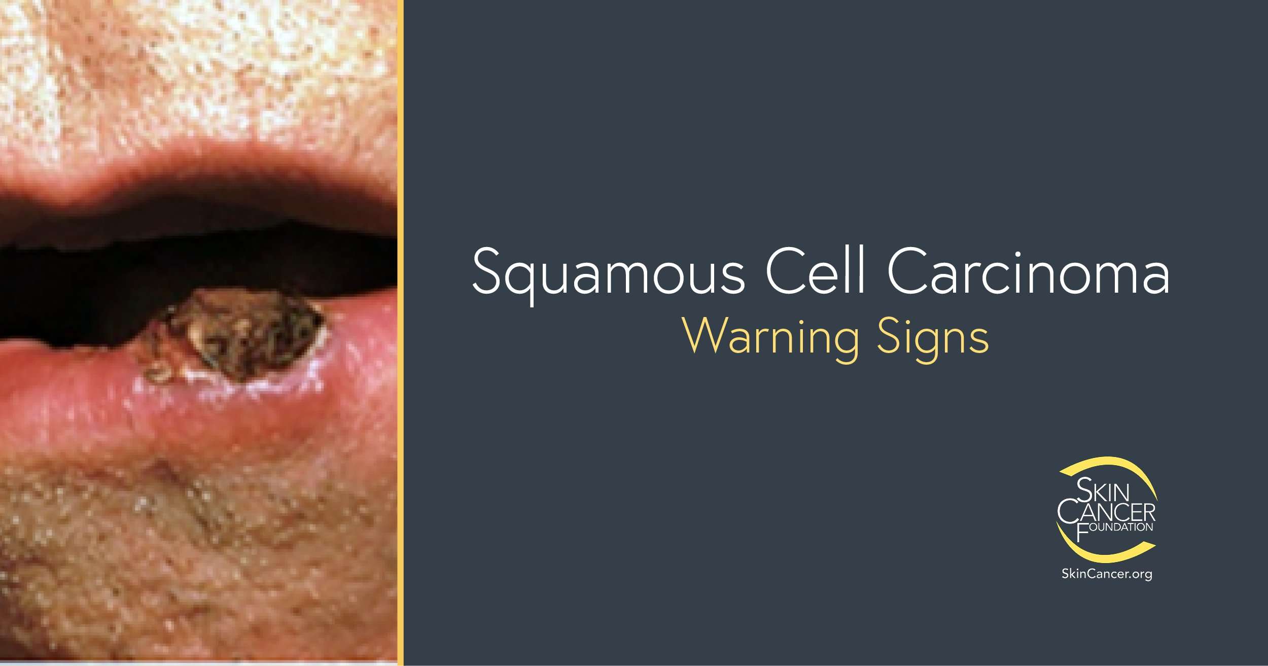 Squamous Cell Carcinoma Warning Signs and Images