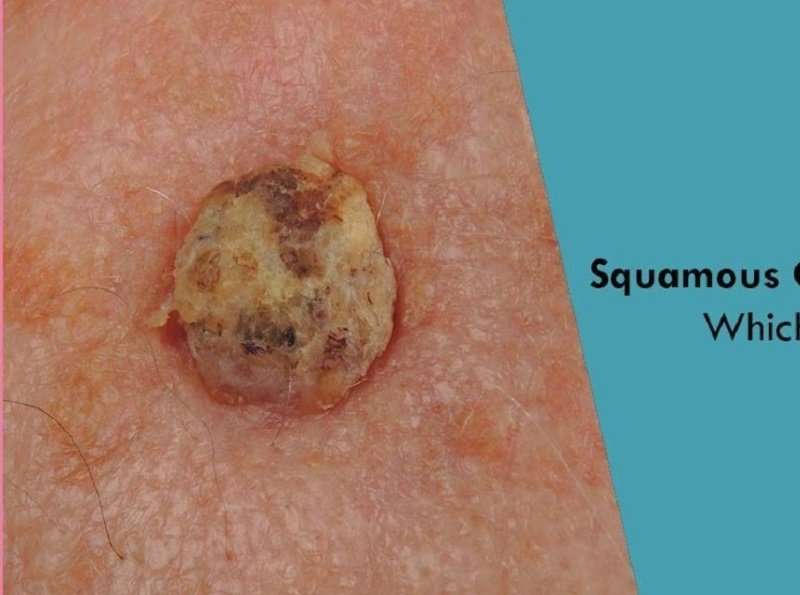 SQUAMOUS OR BASAL CELL CANCER: WHICH ONE IS WORSE? by ...
