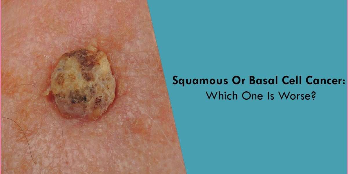 Squamous Or Basal Cell Cancer: Which One is Worse?