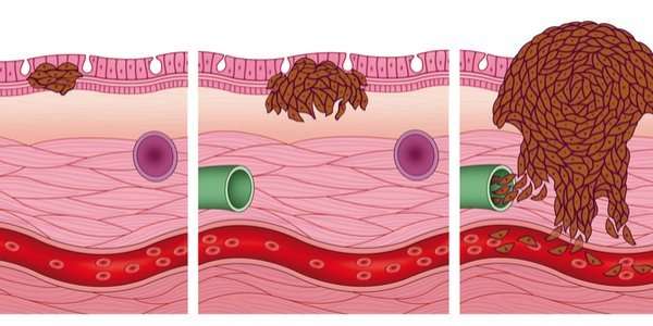 Stage 0 Melanoma (in Situ) Risks & Treatment