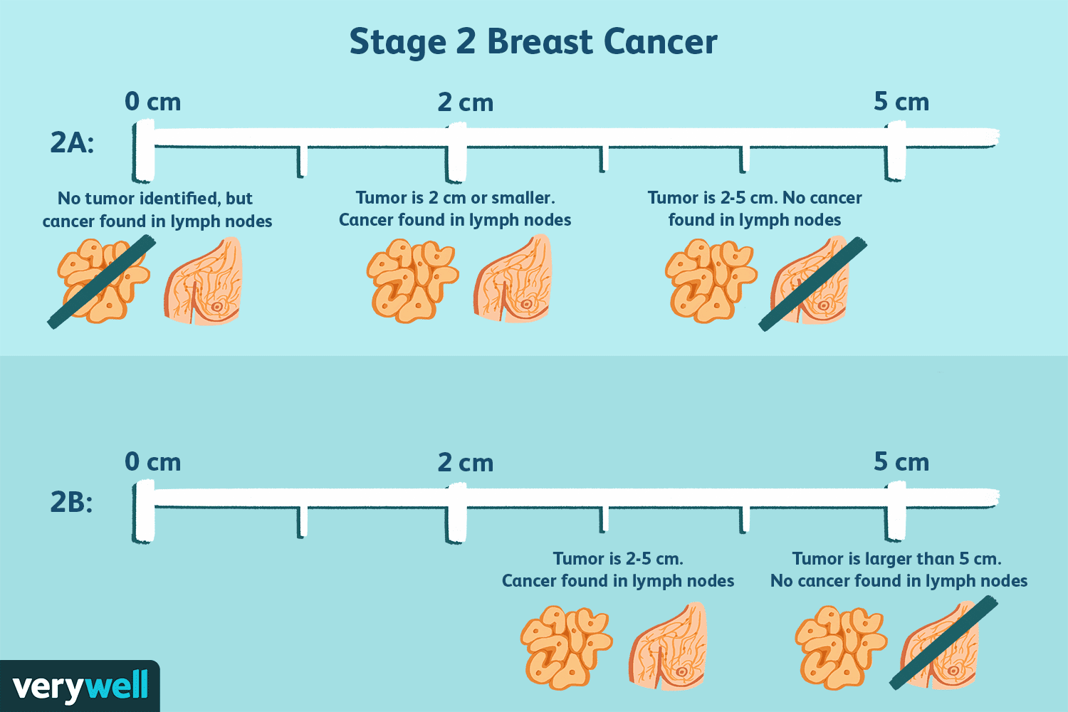 Stage 2 Breast Cancer: Diagnosis, Treatment, Survival