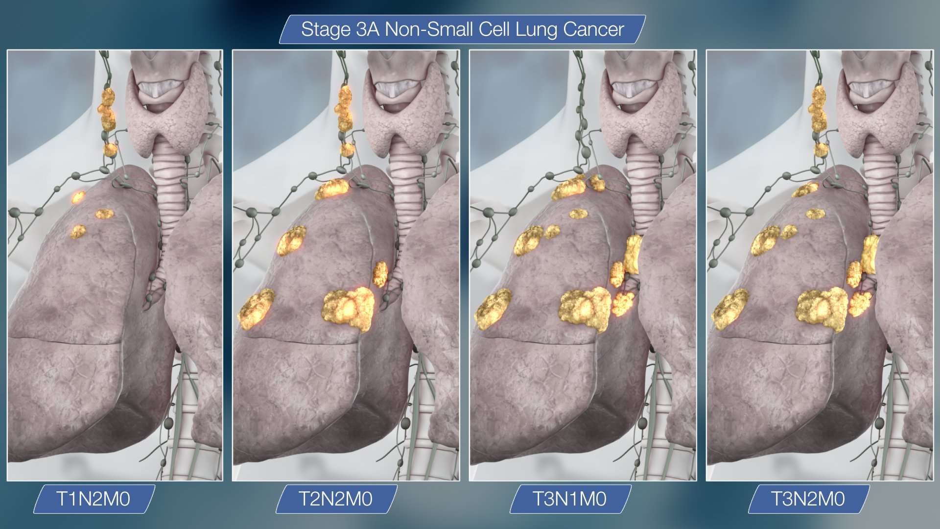 Stage 3 Lung Cancer : All that you need to know ...