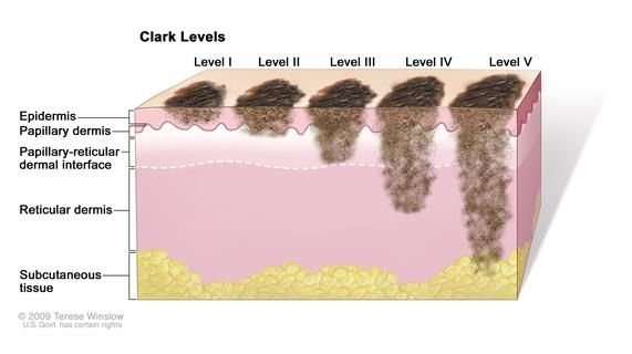 Stage 3 Skin Cancer