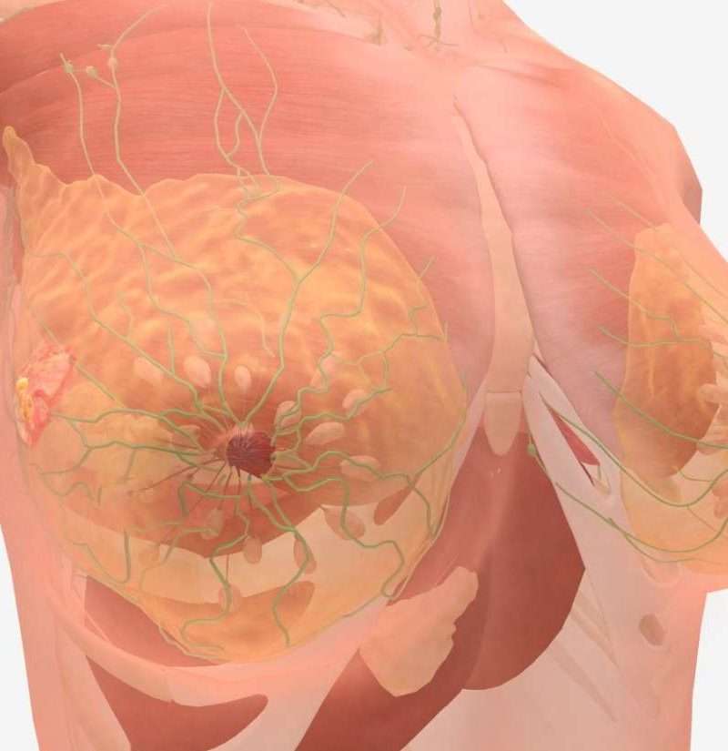 Stage 4 breast cancer symptoms and prognosis