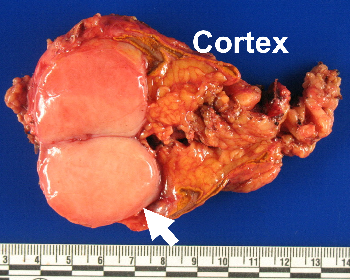 Stage 4 Kidney Cancer That Has Spread To Lungs