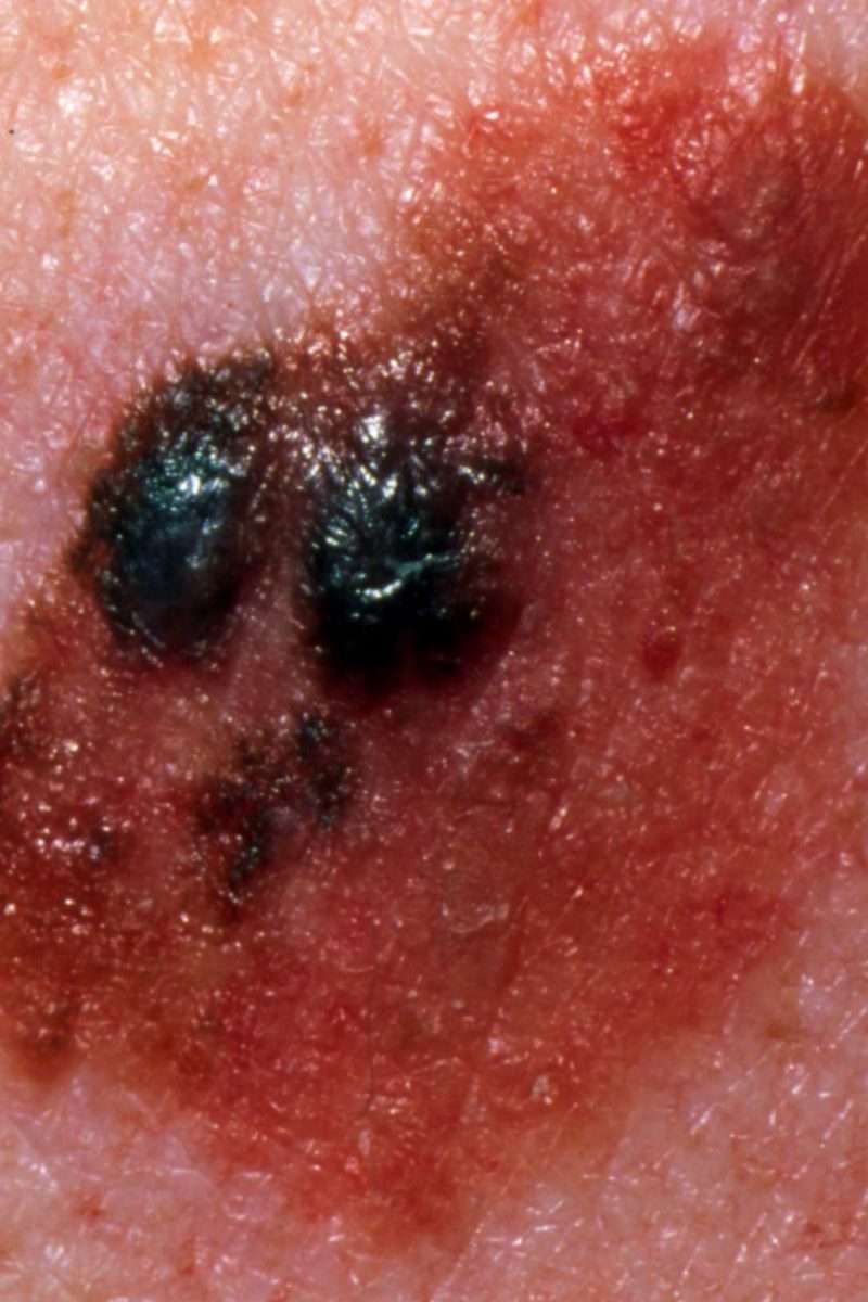 Stage 4 melanoma: Survival rate, pictures, and treatment