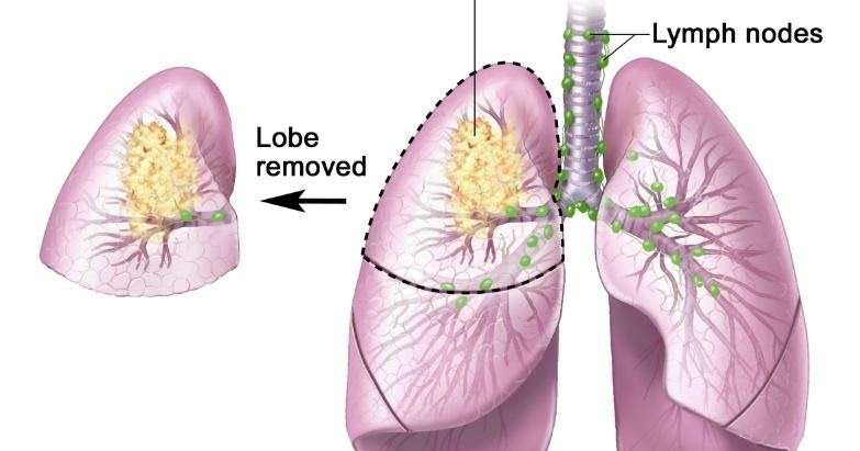 Stage 4 Non Small Cell Lung Cancer Life Expectancy