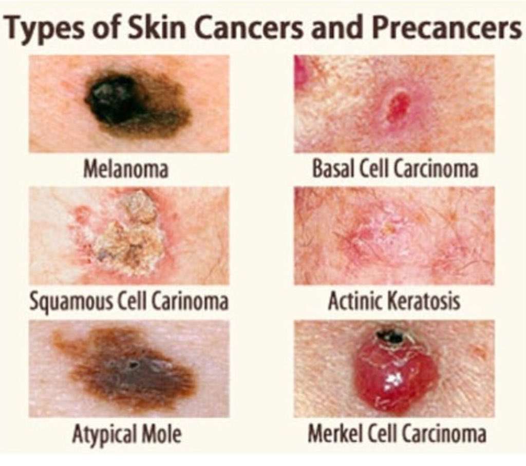 Stage Free Melanoma on Twitter: " We know its not pleasant to look at ...