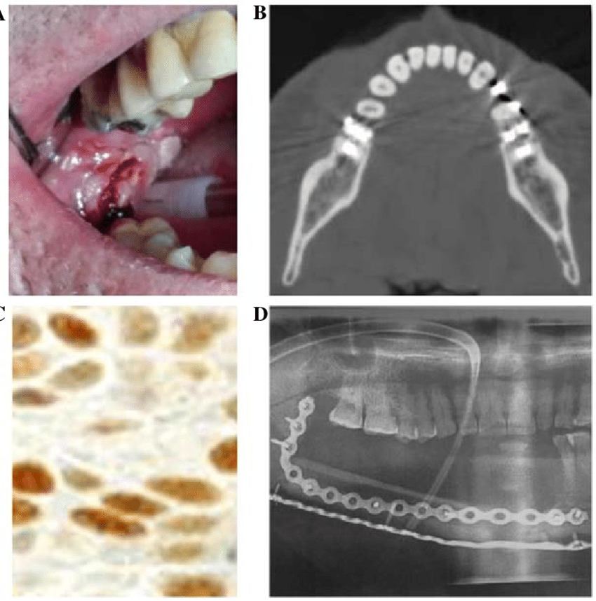 Stage I squamous cell carcinoma of the right retromolar ...
