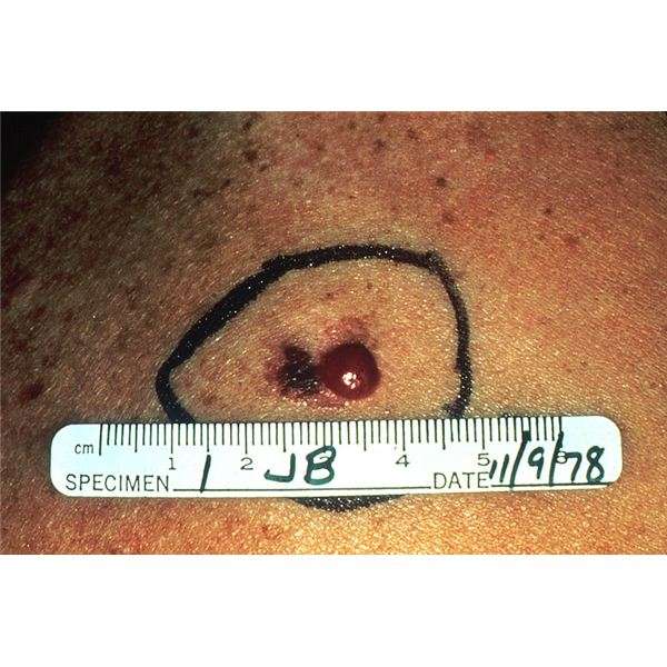 Stages of Melanoma: Growth Patterns and Stages of Skin ...