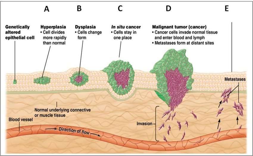 Stages of tumor development and mechanism of metastasis ...