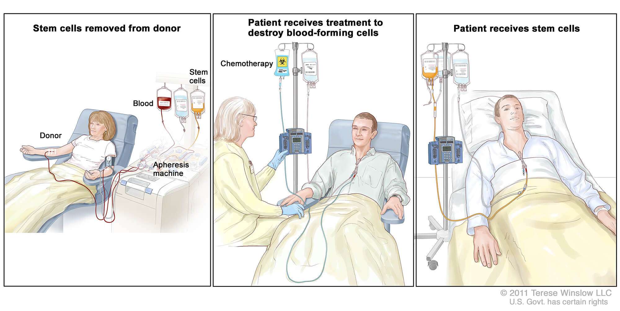 Stem Cell Transplants in Cancer Treatment