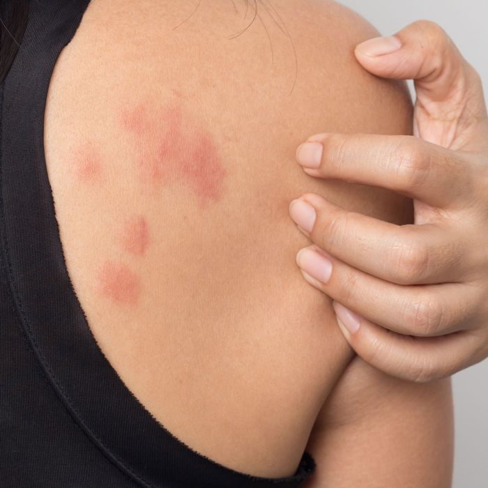 Stress Hives: Causes, Treatment, and More
