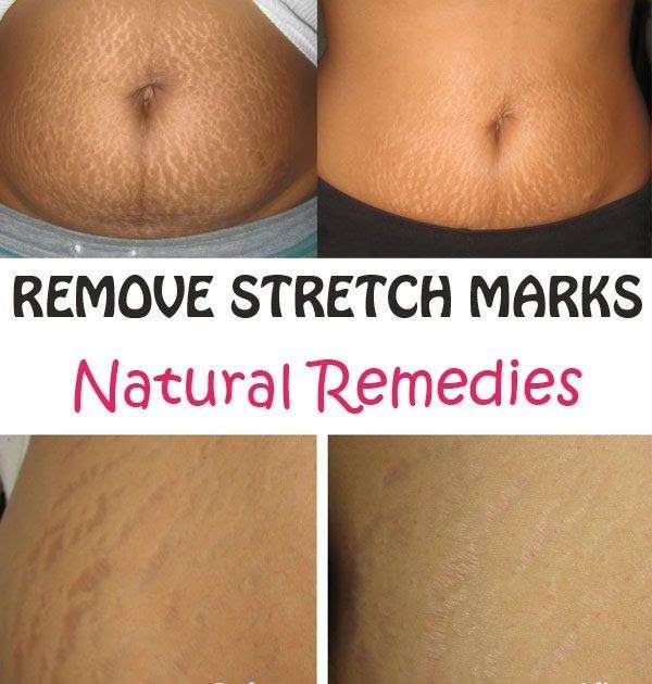Stretch Marks After Weight Loss Dark Skin