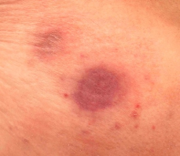 Sudden Black Spot On Skin