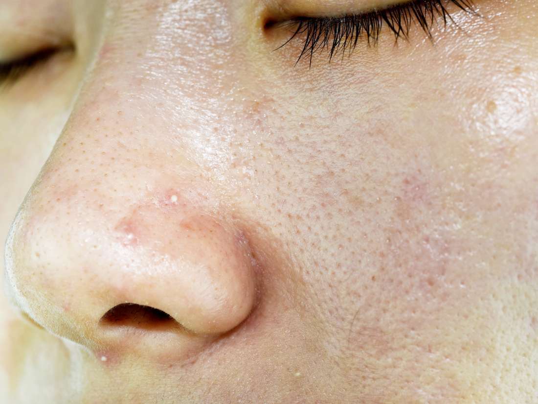 Sudden Oily Skin Causes