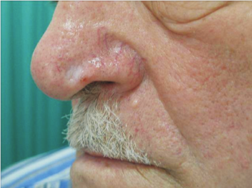 Superficial basal cell carcinoma.