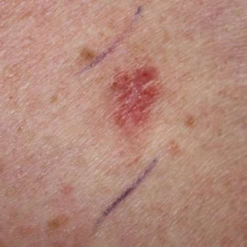 Superficial Skin Cancer Pictures