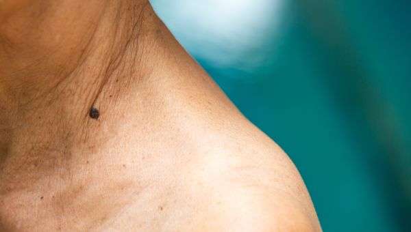 Surprising Spots to Check for Skin Cancer