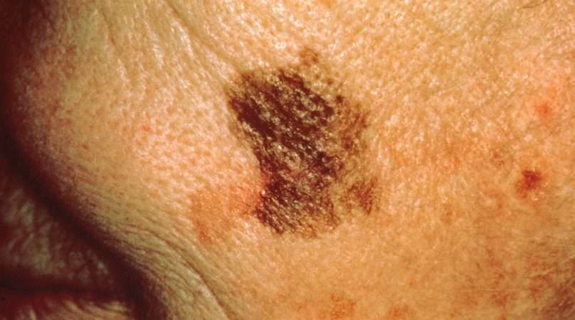 Survival rates of Advanced Skin Cancer soar with novel ...