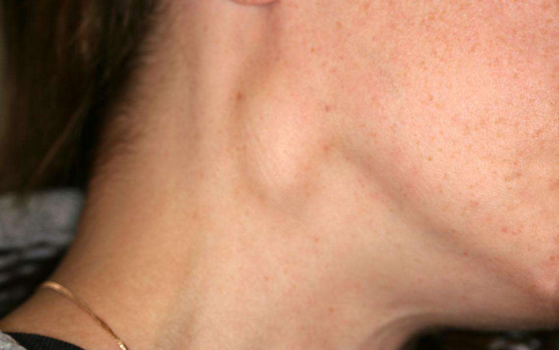 Swollen cervical lymph nodes: What does it mean?
