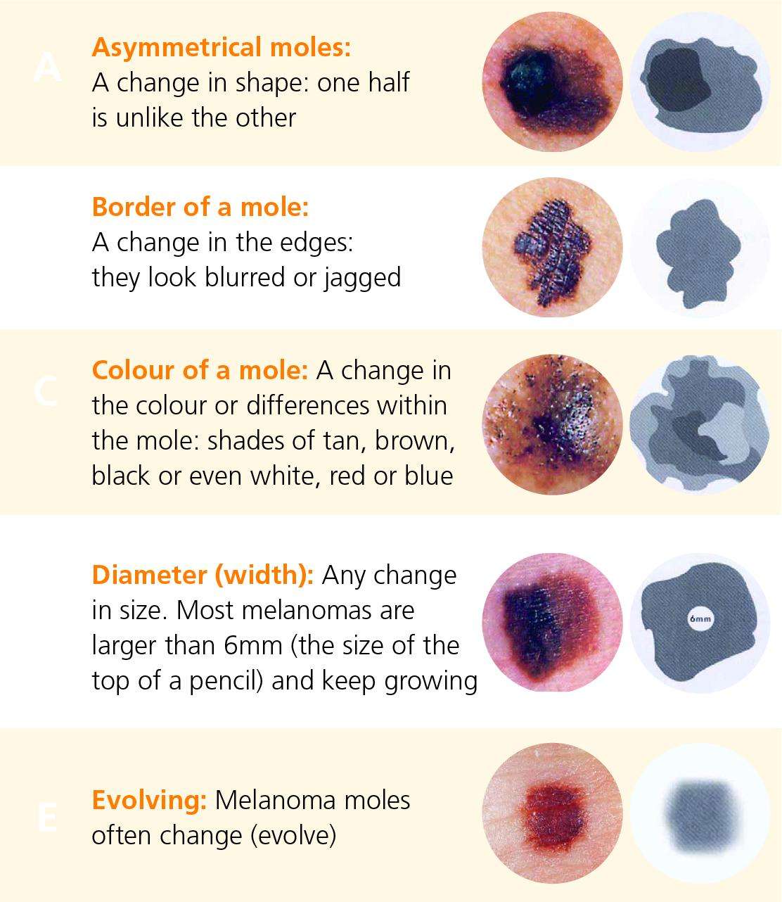 Symptoms and diagnosis of melanoma
