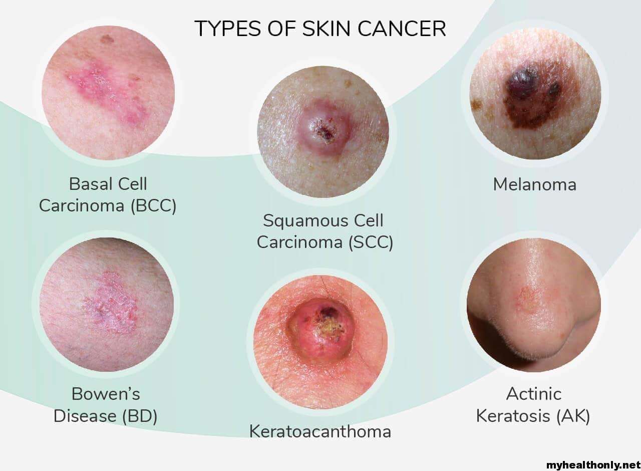 Symptoms of Skin Cancer, Risk Factors, Signs &  Causes