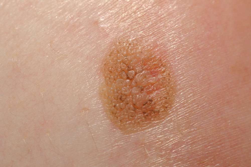 The âABCDEâ Test to Identify the Most Dangerous Form of Skin Cancer ...