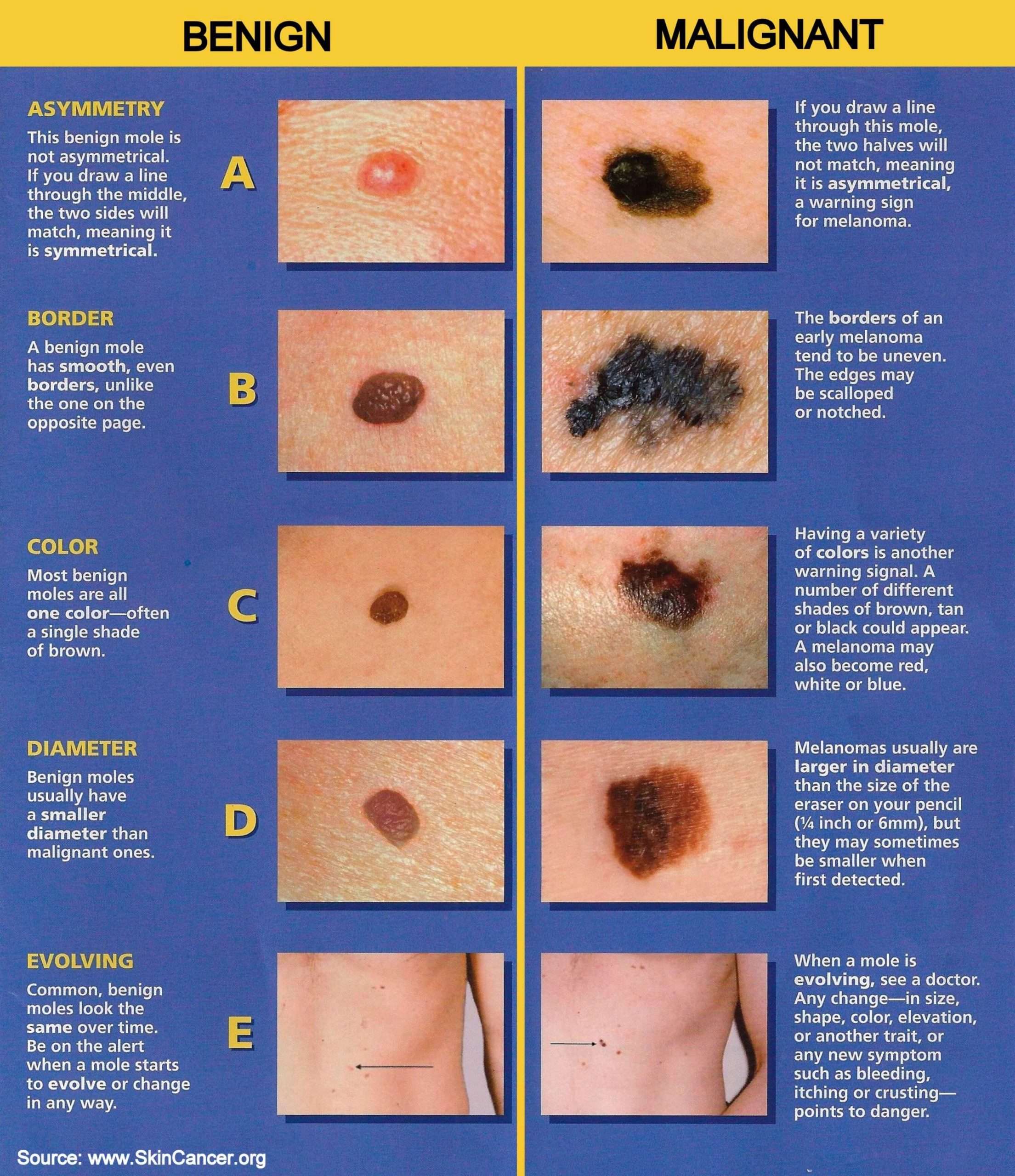 The ABCDE Rule of Skin Cancer