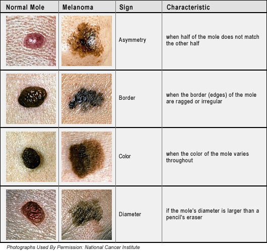 The ABCDEs of Melanoma