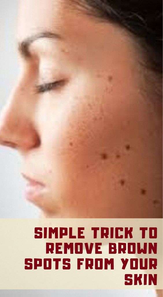 The best way to Remove Darkish Spots From Facial area Within two Days # ...