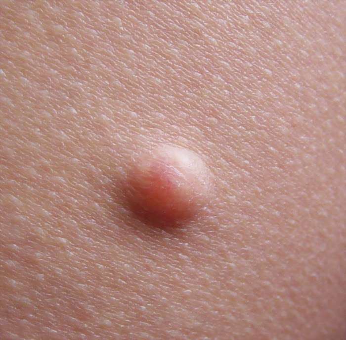 The First Threat Of Skin Cancer