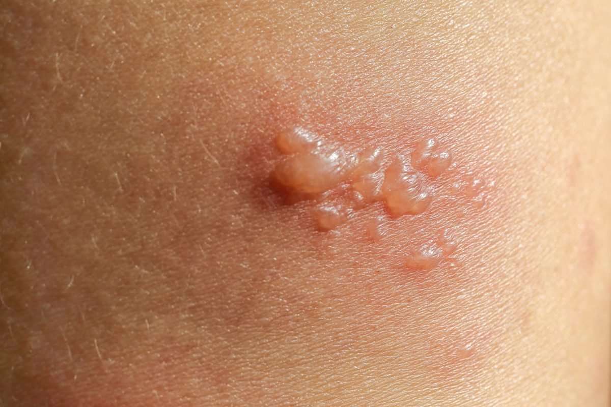 The Most Common Types of Skin Lesions