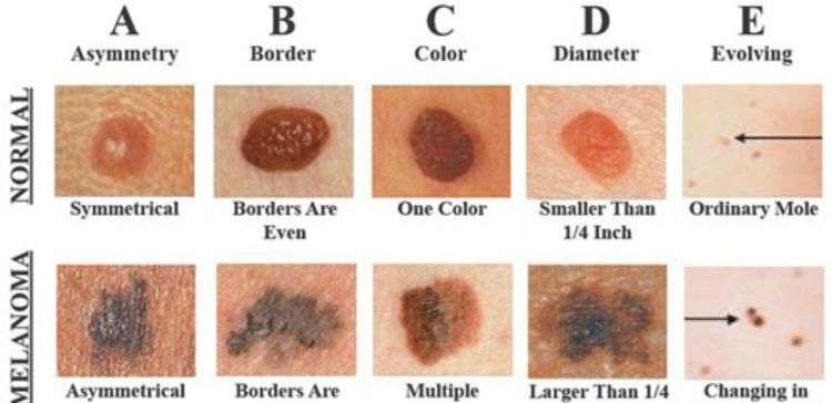 The Skin Cancer Detector That Could Save Your Life