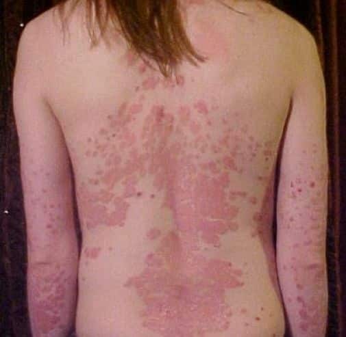 The three diseases that were most associated with psoriasis were ...