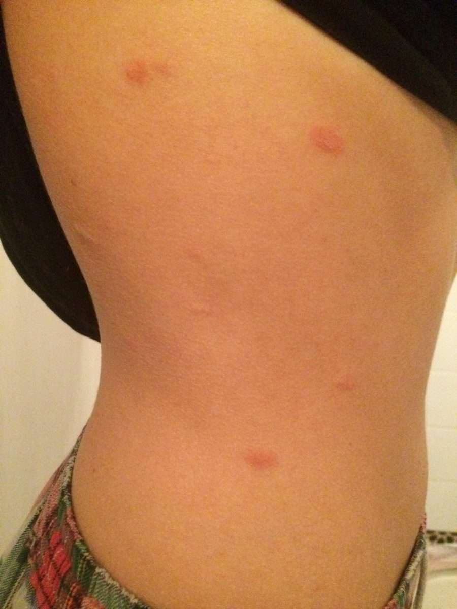 These red itchy bumps have been popping up all over my torso for the ...