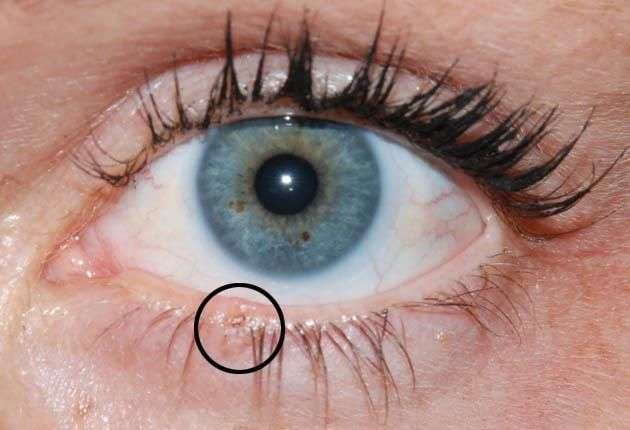 This is a basal cell skin cancer on lower eyelid.
