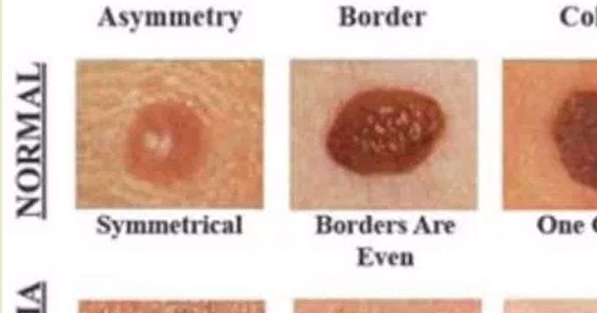 This skin cancer detector guide can save your life
